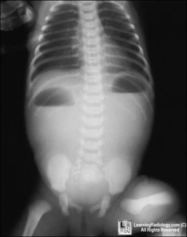 Duodenal atresia